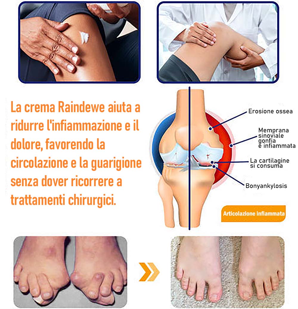 Raindew® Crema Avanzata al Veleno d'Ape per la Guarigione delle Articolazioni e delle Ossa
