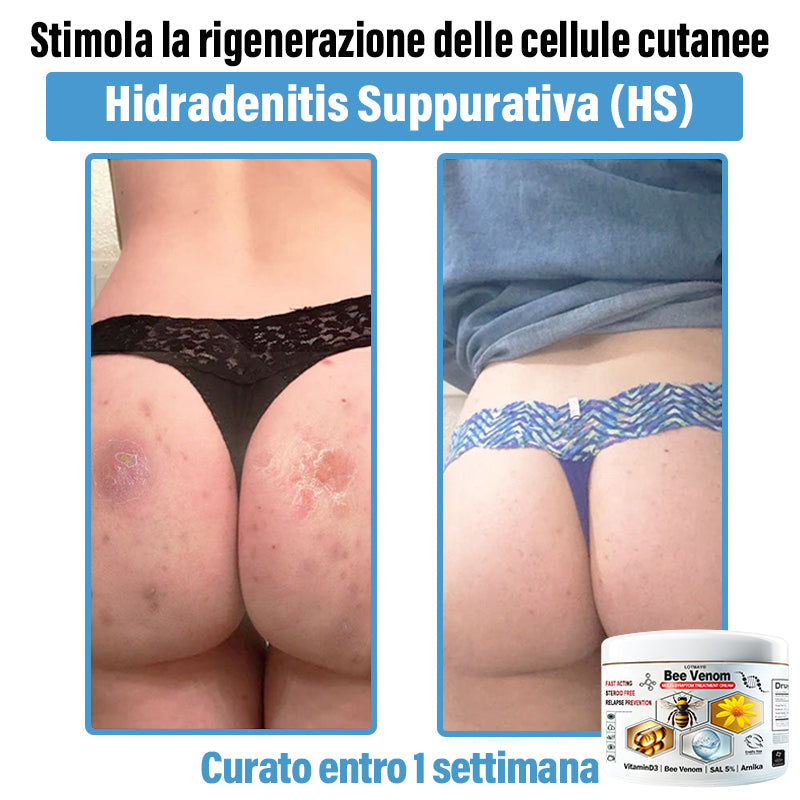 Lotmay® 🔥crema per il trattamento della pelle al veleno d'ape multi-stmptom