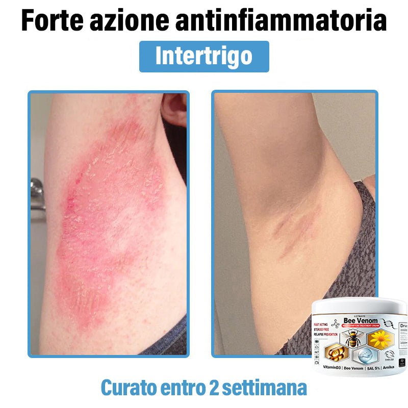 Lotmay® 🔥crema per il trattamento della pelle al veleno d'ape multi-stmptom