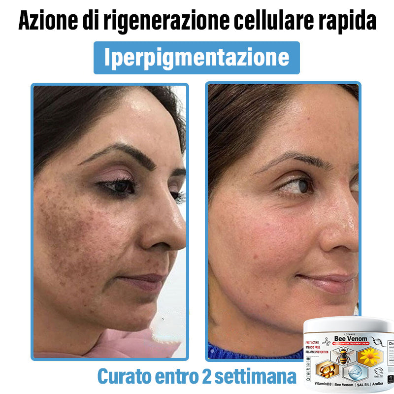 Lotmay® 🔥crema per il trattamento della pelle al veleno d'ape multi-stmptom