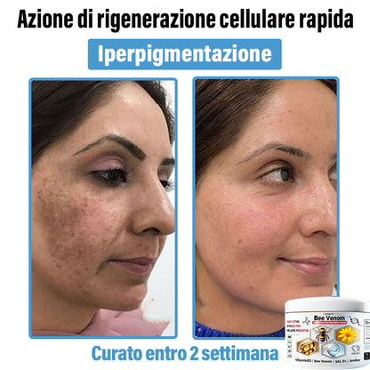 Lotmay® 🔥crema per il trattamento della pelle al veleno d'ape multi-stmptom