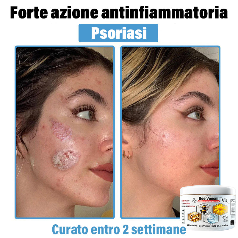 Lotmay® 🔥crema per il trattamento della pelle al veleno d'ape multi-stmptom