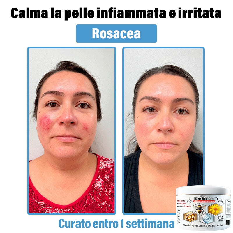 Lotmay® 🔥crema per il trattamento della pelle al veleno d'ape multi-stmptom