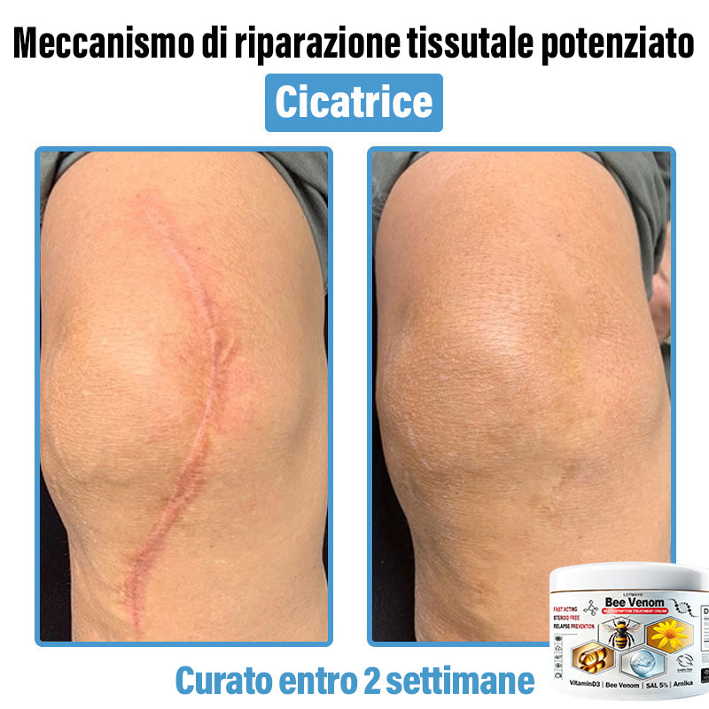 Lotmay® 🔥crema per il trattamento della pelle al veleno d'ape multi-stmptom