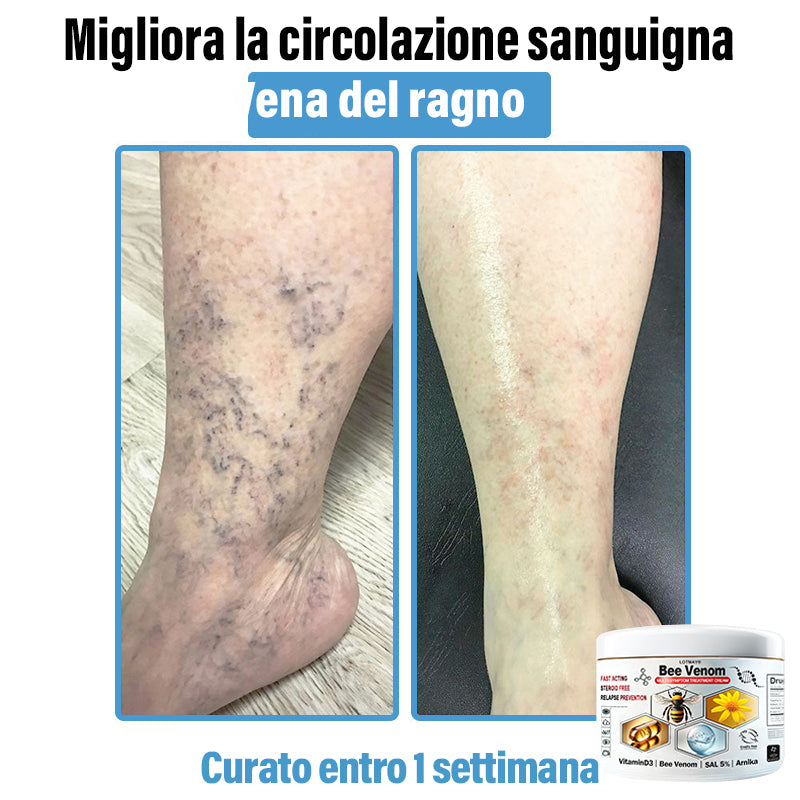 Lotmay® 🔥crema per il trattamento della pelle al veleno d'ape multi-stmptom